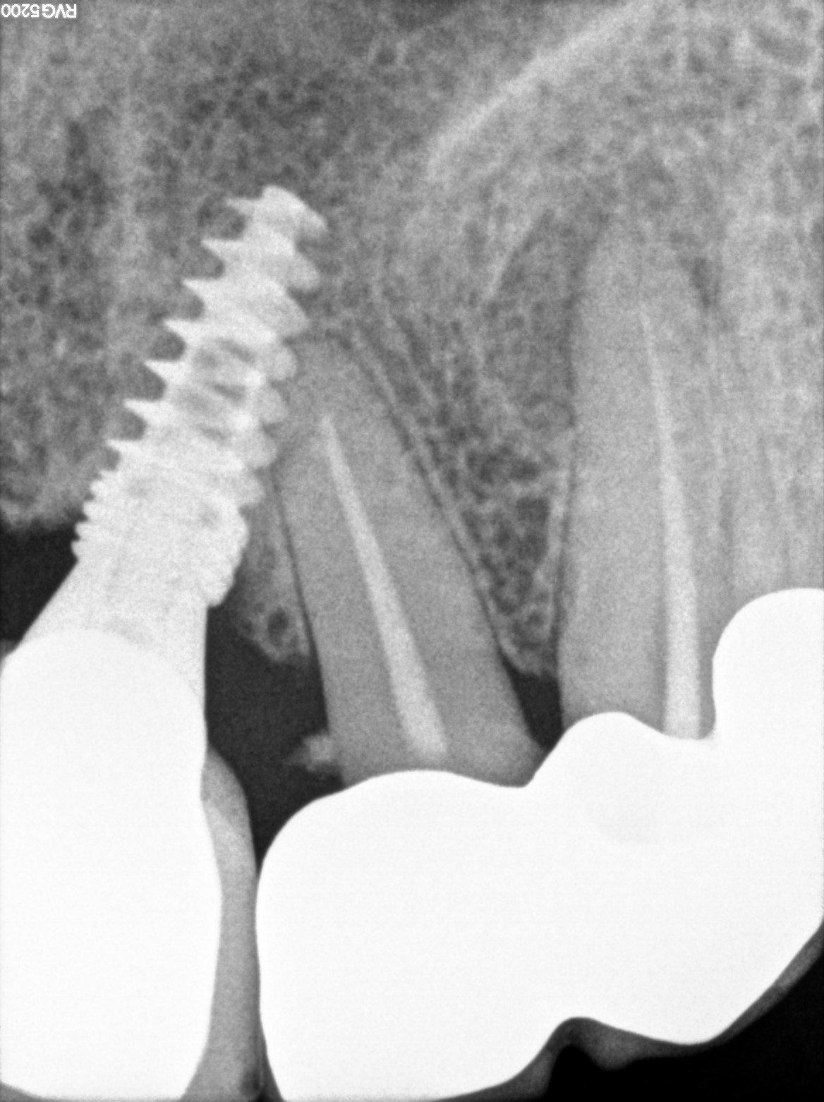 Dental X-ray